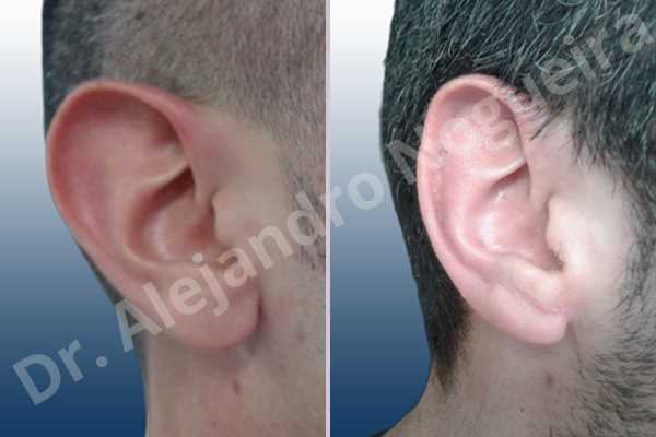 Large earlobes,Large ears,Prominent earlobes,Prominent ears,Fleur de lis cephalic ear resection,L shape earlobe resection - photo 5