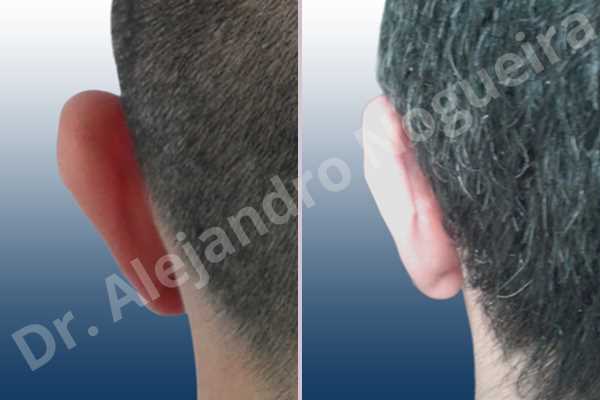 Large earlobes,Large ears,Prominent earlobes,Prominent ears,Fleur de lis cephalic ear resection,L shape earlobe resection - photo 7