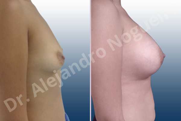 Empty breasts,Lateral breasts,Slightly saggy droopy breasts,Small breasts,Too far apart wide cleavage breasts,Wide breasts,Anatomical shape,Lower hemi periareolar incision,Subfascial pocket plane - photo 4