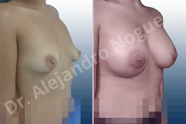 Empty breasts,Lateral breasts,Slightly saggy droopy breasts,Small breasts,Too far apart wide cleavage breasts,Wide breasts,Anatomical shape,Lower hemi periareolar incision,Subfascial pocket plane - photo 5