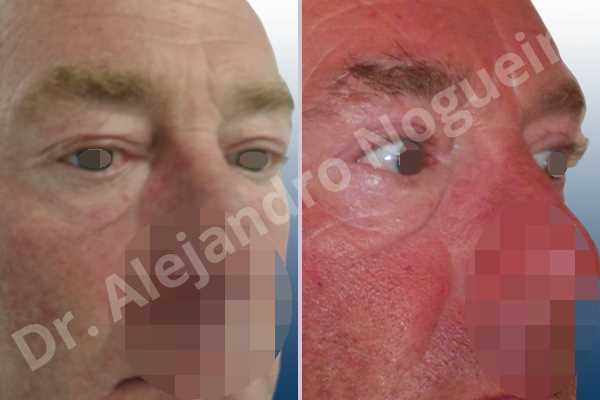 Baggy lower eyelids,Saggy upper eyelids,Upper eyelids ptosis,Lower eyelid fat bags resection,Transconjunctival approach incision,Upper eyelid skin and muscle resection - photo 5