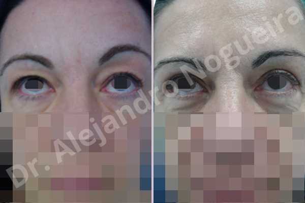 Baggy upper eyelids,Saggy upper eyelids,Upper eyelid fat bags resection,Upper eyelid skin and muscle resection - photo 2