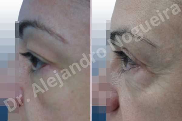 Baggy upper eyelids,Saggy upper eyelids,Upper eyelid fat bags resection,Upper eyelid skin and muscle resection - photo 3