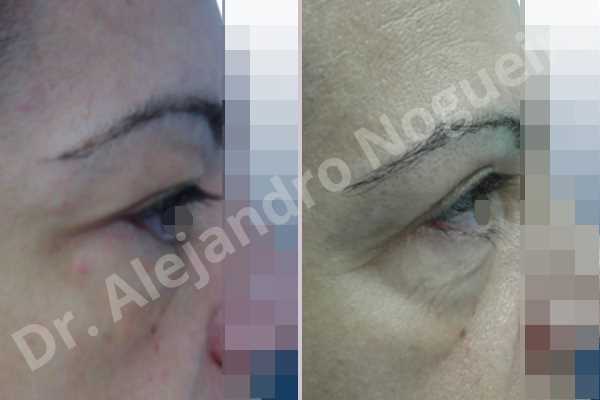 Baggy upper eyelids,Saggy upper eyelids,Upper eyelid fat bags resection,Upper eyelid skin and muscle resection - photo 5