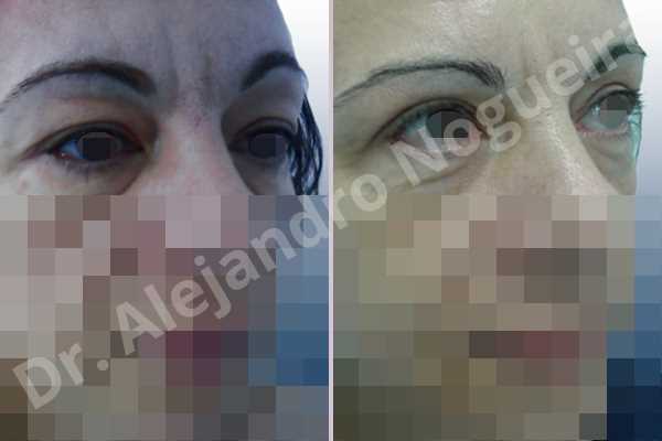 Baggy upper eyelids,Saggy upper eyelids,Upper eyelid fat bags resection,Upper eyelid skin and muscle resection - photo 6