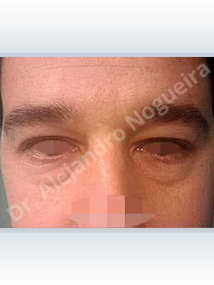 Baggy lower eyelids,Lower eyelid fat bags resection,Transconjunctival approach incision