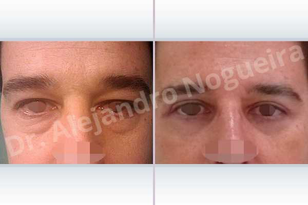 Baggy lower eyelids,Lower eyelid fat bags resection,Transconjunctival approach incision - photo 1