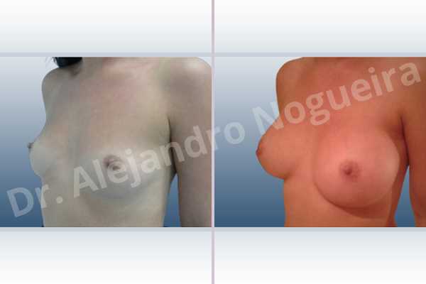 Cross eyed breasts,Empty breasts,Lateral breasts,Narrow breasts,Skinny breasts,Small breasts,Sunken chest,Too far apart wide cleavage breasts,Anatomical shape,Inframammary incision,Subfascial pocket plane - photo 3