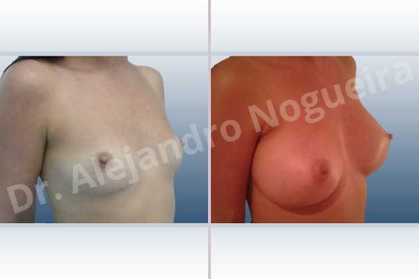 Cross eyed breasts,Empty breasts,Lateral breasts,Narrow breasts,Skinny breasts,Small breasts,Sunken chest,Too far apart wide cleavage breasts,Anatomical shape,Inframammary incision,Subfascial pocket plane - photo 5
