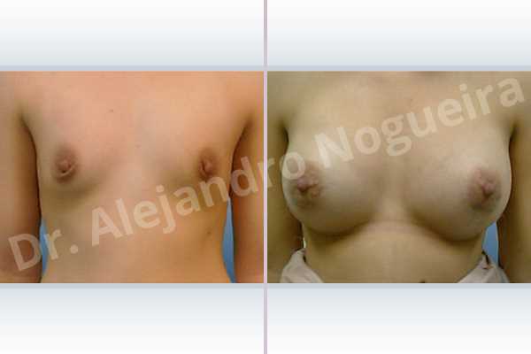 Empty breasts,Large areolas,Lateral breasts,Narrow breasts,Slightly saggy droopy breasts,Small breasts,Too far apart wide cleavage breasts,Tuberous breasts,Anatomical shape,Lower hemi periareolar incision,Subfascial pocket plane - photo 1