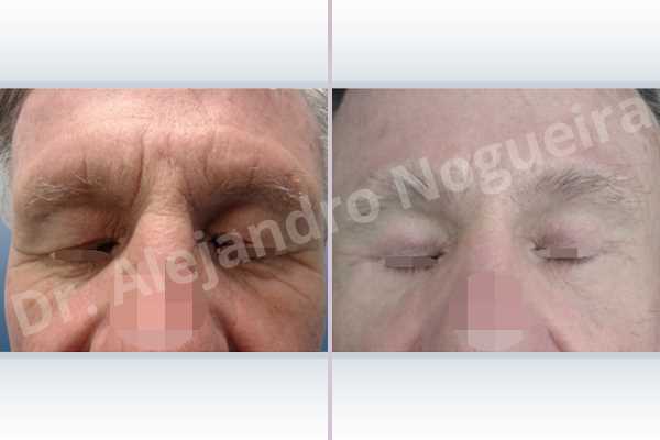 Baggy lower eyelids,Baggy upper eyelids,Deep nasolabial folds,Droopy cheeks,Droopy eyebrows,Droopy face,Droopy forehead,Saggy lower eyelids,Saggy upper eyelids,Upper eyelids ptosis,Lower eyelid fat bags resection,Lower eyelid skin and muscle resection,Lower eyelid wedge resection,Short temporal incisions supraperiosteal extended lift of the upper two thirds of the face,Subciliary approach incision,Upper eyelid fat bags resection,Upper eyelid skin and muscle resection - photo 2