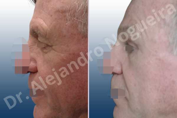 Baggy lower eyelids,Baggy upper eyelids,Deep nasolabial folds,Droopy cheeks,Droopy eyebrows,Droopy face,Droopy forehead,Saggy lower eyelids,Saggy upper eyelids,Upper eyelids ptosis,Lower eyelid fat bags resection,Lower eyelid skin and muscle resection,Lower eyelid wedge resection,Short temporal incisions supraperiosteal extended lift of the upper two thirds of the face,Subciliary approach incision,Upper eyelid fat bags resection,Upper eyelid skin and muscle resection - photo 3