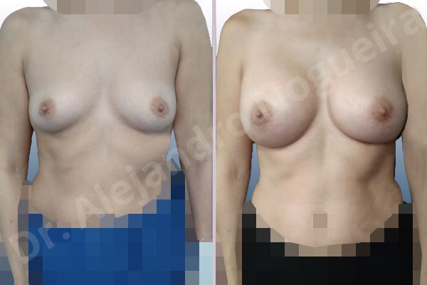 Asymmetric breasts,Empty breasts,Slightly saggy droopy breasts,Small breasts,Wide breasts,Anatomical shape,Lower hemi periareolar incision,Subfascial pocket plane - photo 1