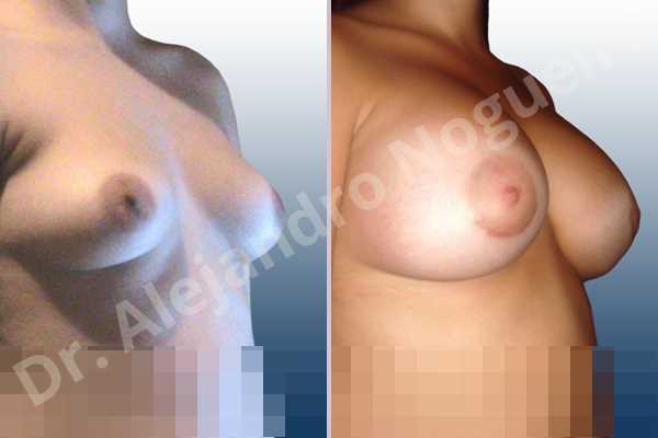 Asymmetric breasts,Empty breasts,Mildly saggy droopy breasts,Slightly saggy droopy breasts,Anatomical shape,Lower hemi periareolar incision,Subfascial pocket plane - photo 5