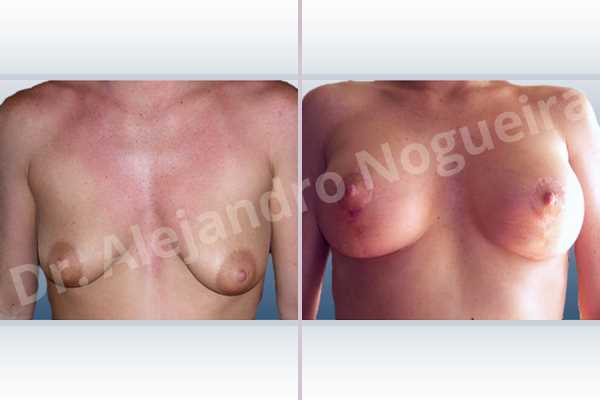 Asymmetric breasts,Empty breasts,Mildly saggy droopy breasts,Moderately saggy droopy breasts,Small breasts,Anatomical shape,Lollipop incision,Subfascial pocket plane,Superior pedicle - photo 1