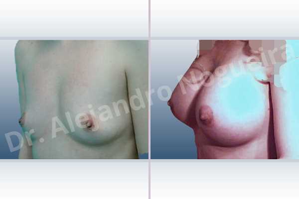 Asymmetric breasts,Empty breasts,Small breasts,Too far apart wide cleavage breasts,Anatomical shape,Extra large size,Lower hemi periareolar incision,Subfascial pocket plane - photo 3