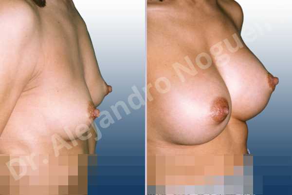 Small breasts,Sunken chest,Anatomical shape,Lower hemi periareolar incision,Subfascial pocket plane - photo 2