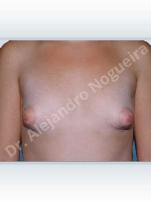 Asymmetric breasts,Cross eyed breasts,Large areolas,Lateral breasts,Narrow breasts,Small breasts,Too far apart wide cleavage breasts,Tuberous breasts,Anatomical shape,Areola reduction,Circumareolar incision,Subfascial pocket plane,Tuberous mammoplasty