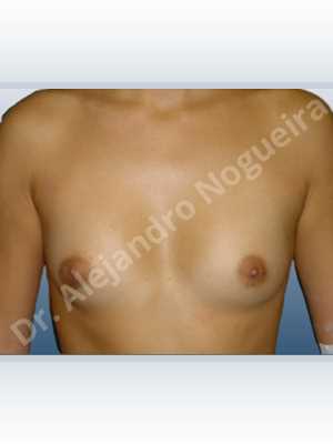 Asymmetric breasts,Cross eyed breasts,Lateral breasts,Narrow breasts,Skinny breasts,Small breasts,Lower hemi periareolar incision,Round shape,Subfascial pocket plane