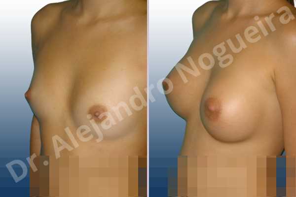 Asymmetric breasts,Cross eyed breasts,Lateral breasts,Narrow breasts,Skinny breasts,Small breasts,Lower hemi periareolar incision,Round shape,Subfascial pocket plane - photo 3