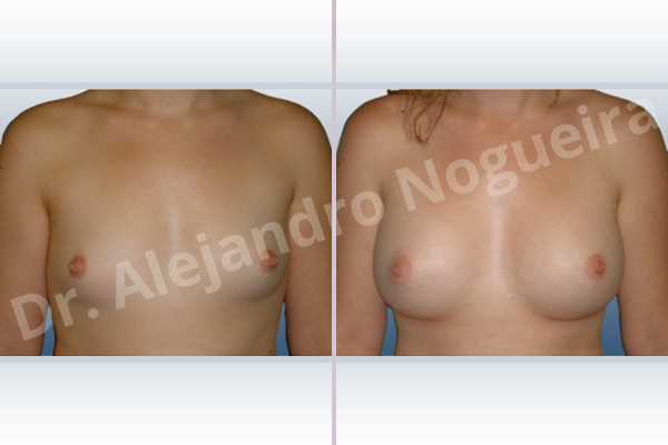 Lateral breasts,Narrow breasts,Small breasts,Too far apart wide cleavage breasts,Anatomical shape,Inframammary incision,Subfascial pocket plane - photo 1