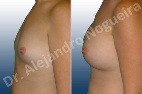 Lateral breasts,Narrow breasts,Small breasts,Too far apart wide cleavage breasts,Anatomical shape,Inframammary incision,Subfascial pocket plane - photo 2