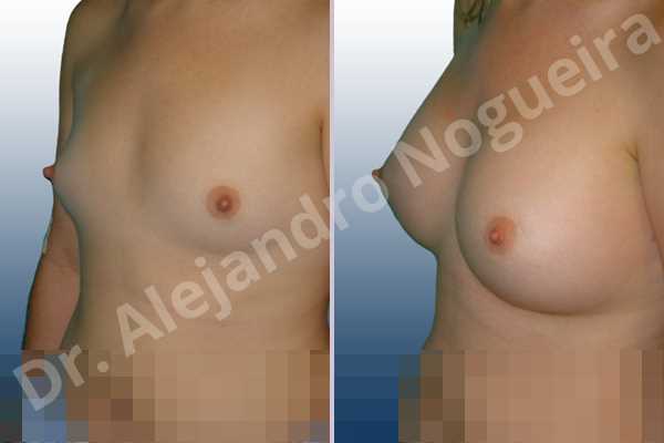 Lateral breasts,Narrow breasts,Small breasts,Too far apart wide cleavage breasts,Anatomical shape,Inframammary incision,Subfascial pocket plane - photo 3