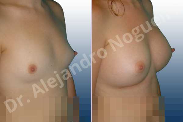Lateral breasts,Narrow breasts,Small breasts,Too far apart wide cleavage breasts,Anatomical shape,Inframammary incision,Subfascial pocket plane - photo 5