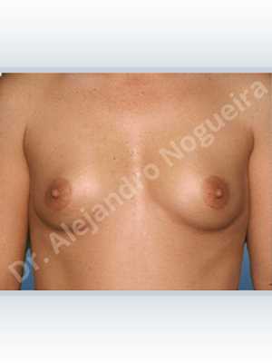 Narrow breasts,Small breasts,Anatomical shape,Lower hemi periareolar incision,Subfascial pocket plane