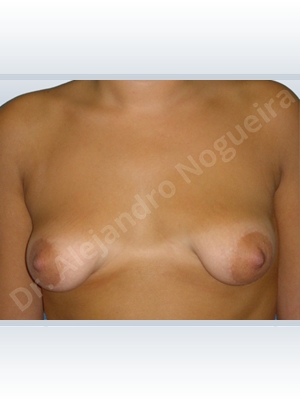 Asymmetric breasts,Empty breasts,Large areolas,Lateral breasts,Mildly saggy droopy breasts,Narrow breasts,Pendulous breasts,Slightly saggy droopy breasts,Small breasts,Too far apart wide cleavage breasts,Tuberous breasts,Wide breasts,Anatomical shape,Areola reduction,Circumareolar incision,Subfascial pocket plane,Tuberous mammoplasty