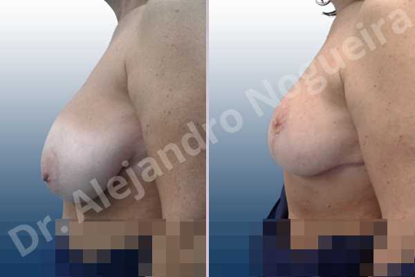 Asymmetric breasts,Breast tissue bottoming out,Extremely saggy droopy breasts,Large areolas,Lateral breasts,Pendulous breasts,Pigeon chest,Severely large breasts,Wide breasts,Tuberous breasts,Anchor incision,Areola reduction,Double vertical pedicle - photo 2