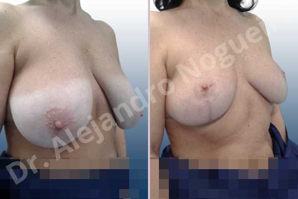 Asymmetric breasts,Breast tissue bottoming out,Extremely saggy droopy breasts,Large areolas,Lateral breasts,Pendulous breasts,Pigeon chest,Severely large breasts,Wide breasts,Tuberous breasts,Anchor incision,Areola reduction,Double vertical pedicle - photo 5
