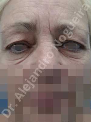 Baggy lower eyelids,Baggy upper eyelids,Saggy lower eyelids,Saggy upper eyelids,Upper eyelids ptosis,Lower eyelid fat bags resection,Lower eyelid skin and muscle resection,Lower eyelid wedge resection,Subciliary approach incision,Upper eyelid fat bags resection,Upper eyelid skin and muscle resection
