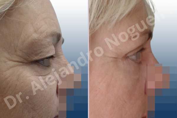 Baggy lower eyelids,Baggy upper eyelids,Saggy lower eyelids,Saggy upper eyelids,Upper eyelids ptosis,Lower eyelid fat bags resection,Lower eyelid skin and muscle resection,Lower eyelid wedge resection,Subciliary approach incision,Upper eyelid fat bags resection,Upper eyelid skin and muscle resection - photo 5