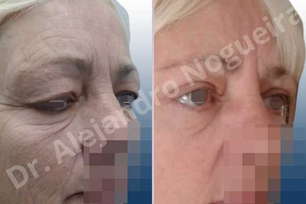 Baggy lower eyelids,Baggy upper eyelids,Saggy lower eyelids,Saggy upper eyelids,Upper eyelids ptosis,Lower eyelid fat bags resection,Lower eyelid skin and muscle resection,Lower eyelid wedge resection,Subciliary approach incision,Upper eyelid fat bags resection,Upper eyelid skin and muscle resection - photo 6