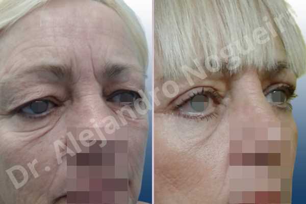 Baggy lower eyelids,Baggy upper eyelids,Saggy lower eyelids,Saggy upper eyelids,Upper eyelids ptosis,Lower eyelid fat bags resection,Lower eyelid skin and muscle resection,Lower eyelid wedge resection,Subciliary approach incision,Upper eyelid fat bags resection,Upper eyelid skin and muscle resection - photo 7