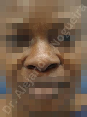 African nose,Afroamerican nose,Alar flaring,Alar rim retraction,Asymmetric tip,Bifid columella,Bifid tip,Boxy tip,Broad dorsum,Broad nose,Bulbous tip,Dynamic alar flaring,Flat dorsum,Hanging columella,Humpless dorsum,Hypertrophic scars,Keloid scars,Large alar cartilages,Large nose,Large nostrils,Large sills,Low dorsum,Low radix,Nasal valve collapse,Pigmented scars,Poorly defined tip,Poorly supported tip,Rounded tip,Saddle nose deformity,Short nose,Short septum,Short upper lateral cartilages,Thick alar rim,Thick skin nose,Underprojected tip,Wide scars,Alar base resection alarplasty,Alar contour rim graft,Alar rim resection,Columella lengthening,Columella strut graft,Custom made tip graft,Dorsocolumella graft,Dorsum replacement graft,Extended columella strut graft,Extended shield tip columella graft,Intercrural columella plasty sutures,Interdomal tip plasty sutures,Lateral cruras batten graft,Lateral cruras caudal extension graft,Lateral cruras custom made graft,Lateral cruras lengthening graft,Lateral cruras replacement graft,Lateral cruras repositioning,Lateral cruras strut graft,Medial cruras custom made graft,Medial cruras lengthening graft,Medial cruras replacement graft,Nostril sill resection,Onlay columella graft,Onlay dorsum graft,Onlay radix graft,Onlay supratip graft,Open approach incision,Rib cartilage graft harvesting,Septum caudal extension graft,Septum replacement graft,Shield tip graft,Tip defatting,Tip replacement graft,Triangular cartilages caudal extension graft