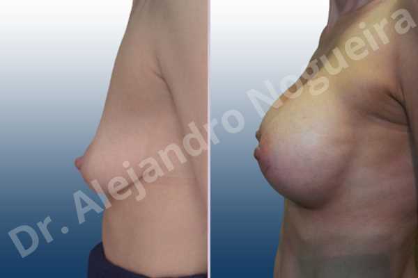 Empty breasts,Moderately saggy droopy breasts,Narrow breasts,Pendulous breasts,Skinny breasts,Small breasts,Extra large size,Lower hemi periareolar incision,Round shape,Subfascial pocket plane - photo 2