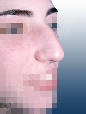 Broad nose,Dorsum hump,Droopy tip,Dynamic alar flaring,Large alar cartilages,Large nose,Long nose,Long upper lateral cartilages,Mediterranean nose,Overprojected tip,Plunging tip deformity,Closed approach incision,Dorsum hump resection,Lateral cruras cephalic resection,Lateral cruras shortening resection,Medial cruras shortening resection,Nasal bones osteotomies,Triangular cartilages caudal resection