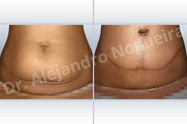 Saggy abdomen,Weak abdomen muscles,Standard abdominoplasty - photo 2
