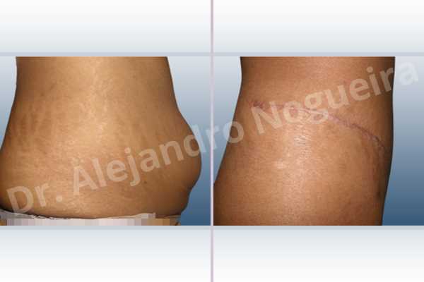 Saggy abdomen,Weak abdomen muscles,Standard abdominoplasty - photo 5