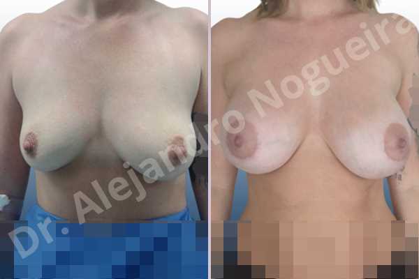 Asymmetric breasts,Empty breasts,Lateral breasts,Moderately large breasts,Moderately saggy droopy breasts,Pendulous breasts,Pigeon chest,Severely saggy droopy breasts,Small breasts,Too far apart wide cleavage breasts,Wide scars,Anatomical shape,Lower hemi periareolar incision,Subfascial pocket plane - photo 1