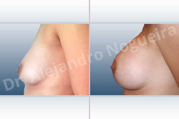 Empty breasts,Slightly saggy droopy breasts,Small breasts,Anatomical shape,Extra large size,Lower hemi periareolar incision,Subfascial pocket plane - photo 2