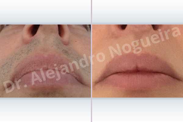 Small lips,Transgender lips,Upper lip autologous dermis collagen filler - photo 2