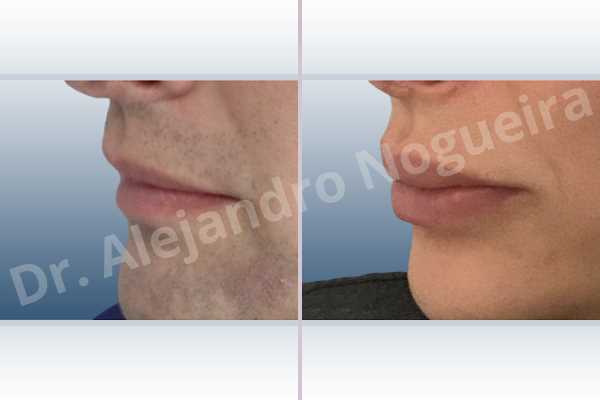 Small lips,Transgender lips,Upper lip autologous dermis collagen filler - photo 3
