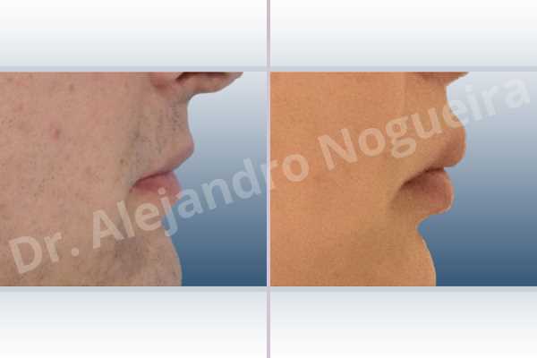 Small lips,Transgender lips,Upper lip autologous dermis collagen filler - photo 5