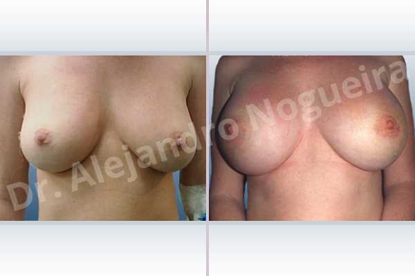 Asymmetric breasts,Empty breasts,Mildly saggy droopy breasts,Small breasts,Too far apart wide cleavage breast implants,Too narrow breast implants,Wide breasts,Anatomical shape,Capsulectomy,Extra large size,Lower hemi periareolar incision,Subfascial pocket plane - photo 1