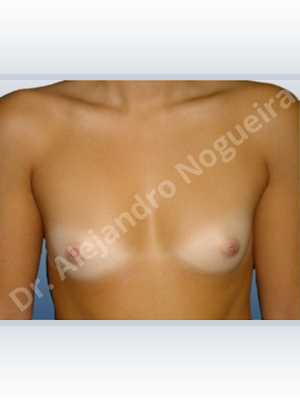 Cross eyed breasts,Narrow breasts,Small breasts,Anatomical shape,Inframammary incision,Subfascial pocket plane