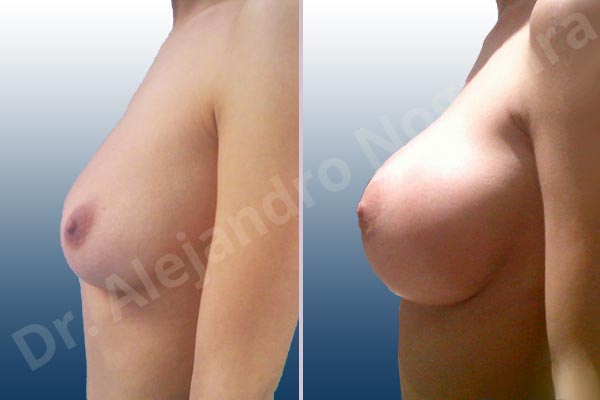 Empty breasts,Lateral breasts,Slightly saggy droopy breasts,Small breasts,Extra large size,Lower hemi periareolar incision,Round shape,Subfascial pocket plane - photo 2