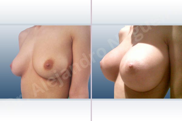 Empty breasts,Lateral breasts,Slightly saggy droopy breasts,Small breasts,Extra large size,Lower hemi periareolar incision,Round shape,Subfascial pocket plane - photo 3